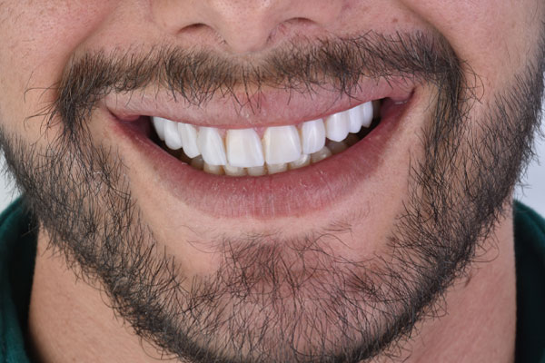 بهترین انتخاب برای ایمپلنت دندان در دماوند و تهران